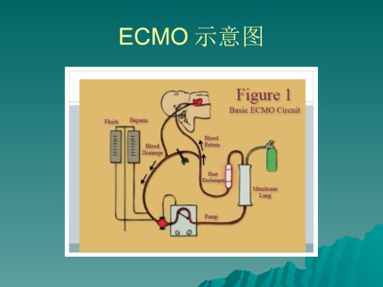 体外膜肺氧合—— ECMO第8页