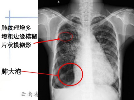 肺水肿的X线表现第5页